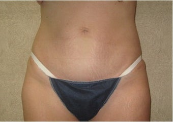 Abdominoplasty after 142554