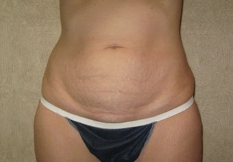 Abdominoplasty before 142554