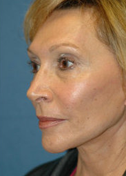 Mini Lift Surgery and Injectable Fillers after 324015
