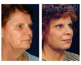 Facial Rejuvenation after 395143