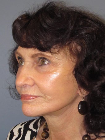 Lite Lift™, Eyelid Lift after 523297