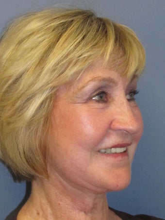 Lite Lift™, Eyelid lift, brow lift, Liposuction to chin after 523310