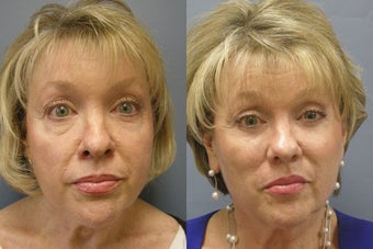Lite Lift™ after 523325