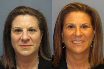Lite Lift, brow lift, blue peel, eyelid lift after 523446