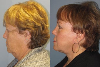 Lite Lift, liposuction of the neck, eyelid lift, brow lift after 523453