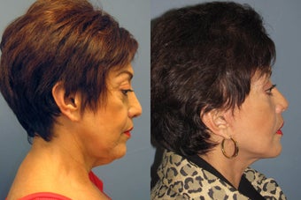 Lite Lift, neck lift, eyelid lift after 523456