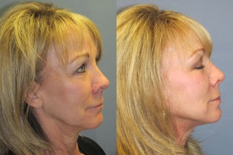 Lite Lift, Liposuction of the neck, blue peel, brow lift after 523492