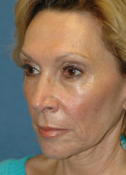 Mini Lift Surgery and Injectable Fillers before 324015