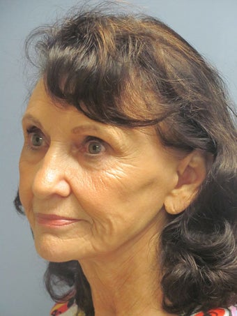 Lite Lift™, Eyelid Lift before 523297