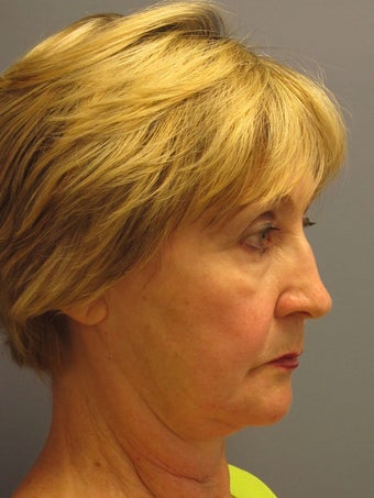 Lite Lift™, Eyelid lift, brow lift, Liposuction to chin before 523310