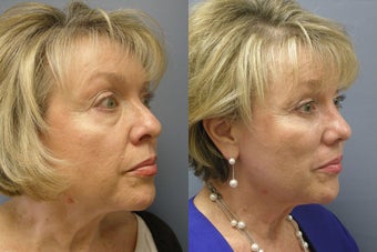 Lite Lift™ before 523325