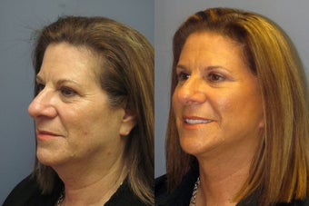 Lite Lift, brow lift, blue peel, eyelid lift before 523446