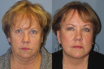 Lite Lift, liposuction of the neck, eyelid lift, brow lift before 523453