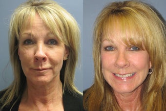 Lite Lift, Liposuction of the neck, blue peel, brow lift before 523492