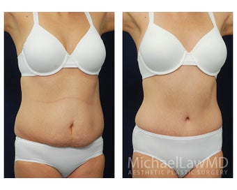 Abdominoplasty - Tummy Tuck after 396063