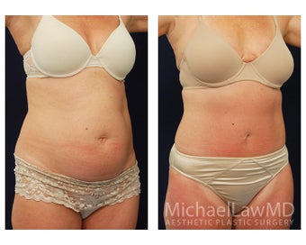 Abdominoplasty - Tummy Tuck after 396111