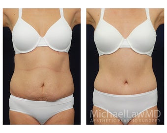 Abdominoplasty - Tummy Tuck before 396063