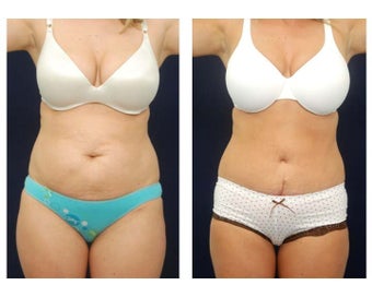 Abdominoplasty - Tummy Tuck before 396151