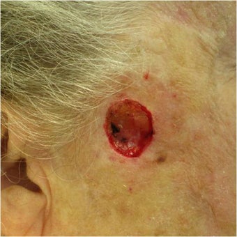 Closure of Mohs Surgery Defect before 82499