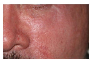 Mohs Surgery after 315879