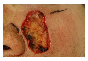 Mohs Surgery before 315879