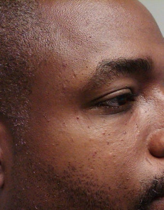 removal of dermatosis papulos nigra after 298228