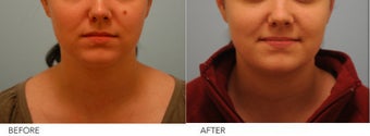 Mole Removal before 267692