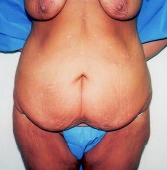 Breast Augmentation with an Abdominoplasty (Tummy Tuck)