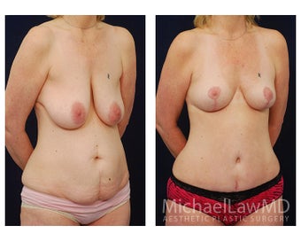 Mommy Makeover after 398688