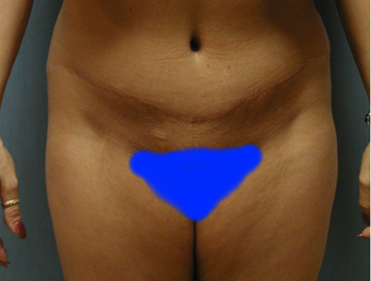 Mommy Makeover- Tummy Tuck and Breast Augmentation after 409607