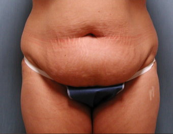 Mommy Makeover- Tummy Tuck and Breast Augmentation before 409607
