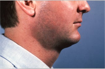 Necklift after 101597