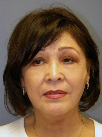 Neck Lift, Platysmaplasty after 634728