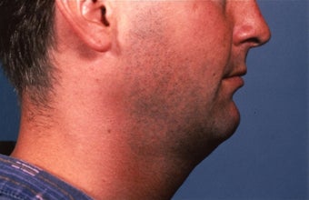 Necklift before 101597