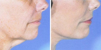 Neck Lift before 643038