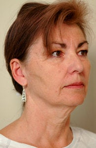 Neck Lift before 65351