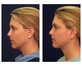 Neck Lift & Lower Facial Rejuvenation after 376152