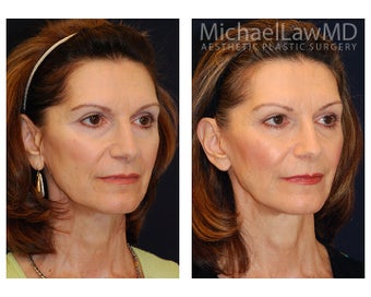 Facial Rejuvenation after 393311