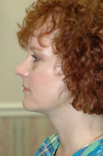 Neck lift, eyelid surgery after 437149