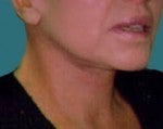Neck Lift after 519257