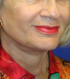 Neck Lift after 531123
