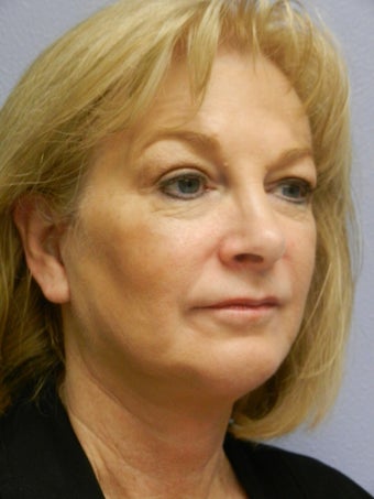 Neck Lift after 558372