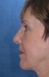 Neck Lift after 324029