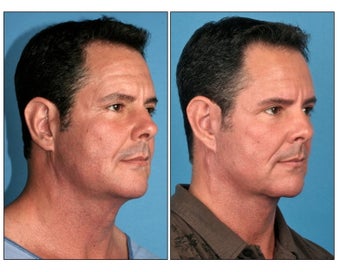 Neck Lift before 331118