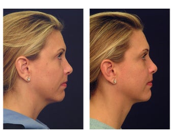 Neck Lift & Lower Facial Rejuvenation before 376152