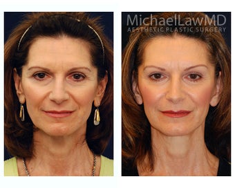 Facial Rejuvenation before 393311
