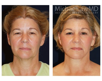 Facial Rejuvenation - Neck Lift before 395329