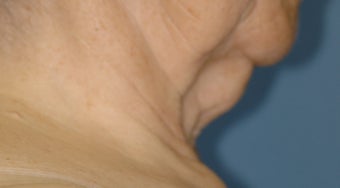 Neck Lift before 537410