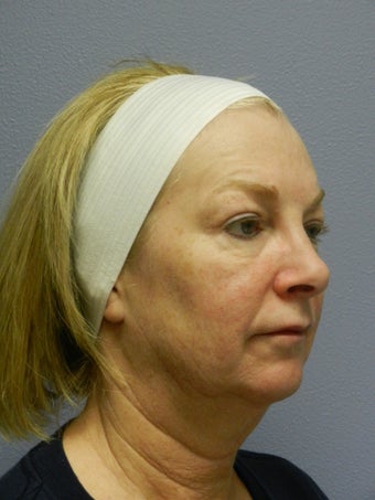 Neck Lift before 558372