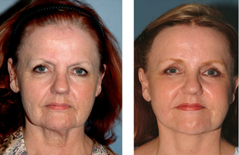 Neck Lift before 575390